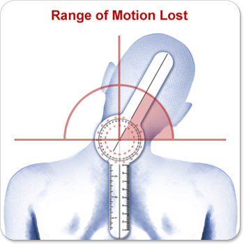 Goniometer placed on patient's back indicating lost range of motion.