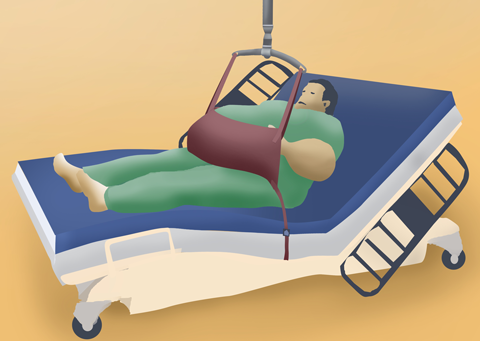 illustration: pannus sling